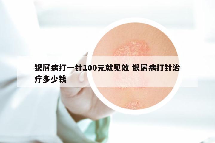 银屑病打一针100元就见效 银屑病打针治疗多少钱