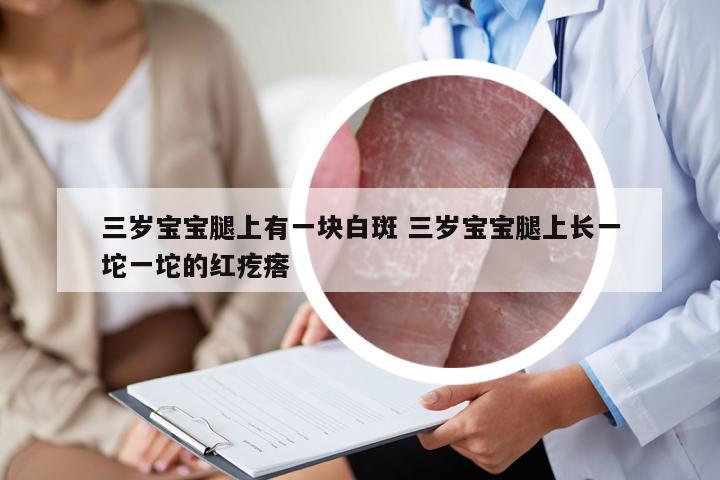 三岁宝宝腿上有一块白斑 三岁宝宝腿上长一坨一坨的红疙瘩