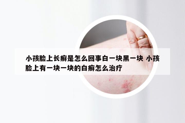 小孩脸上长癣是怎么回事白一块黑一块 小孩脸上有一块一块的白癣怎么治疗