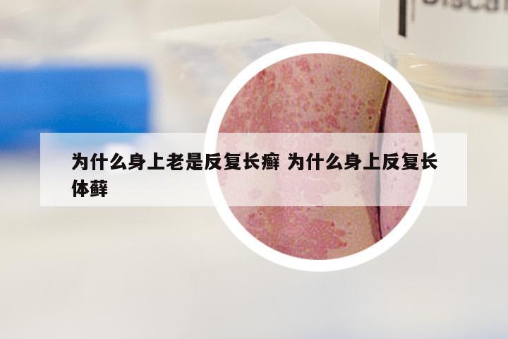 为什么身上老是反复长癣 为什么身上反复长体藓