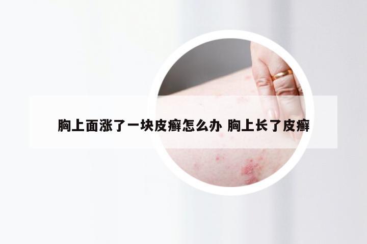 胸上面涨了一块皮癣怎么办 胸上长了皮癣