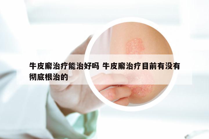 牛皮廨治疗能治好吗 牛皮廨治疗目前有没有彻底根治的