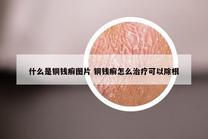 什么是铜钱癣图片 铜钱癣怎么治疗可以除根