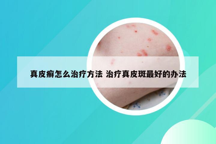 真皮癣怎么治疗方法 治疗真皮斑最好的办法