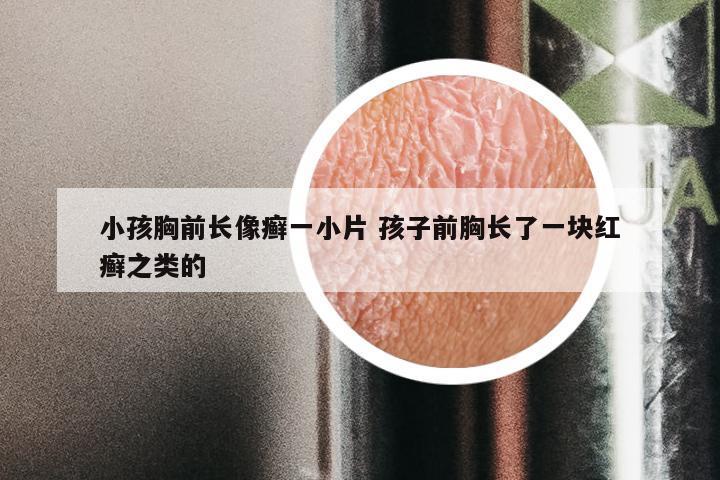 小孩胸前长像癣一小片 孩子前胸长了一块红癣之类的