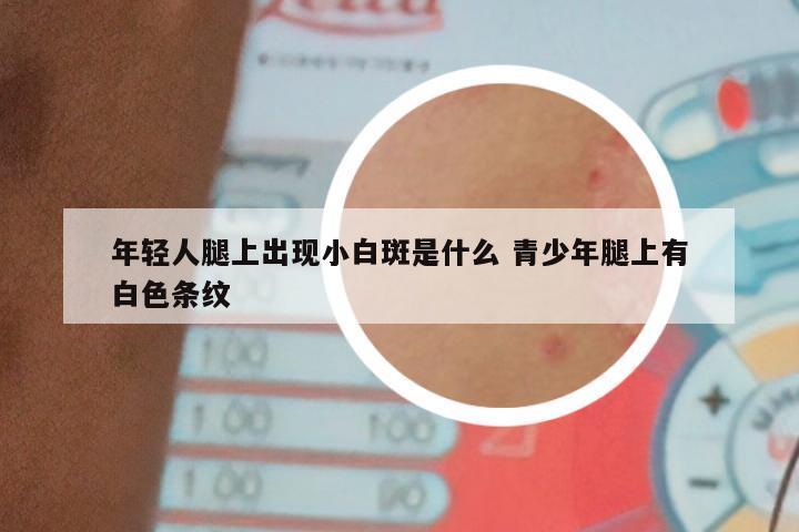 年轻人腿上出现小白斑是什么 青少年腿上有白色条纹