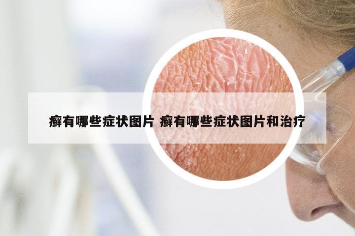 癣有哪些症状图片 癣有哪些症状图片和治疗
