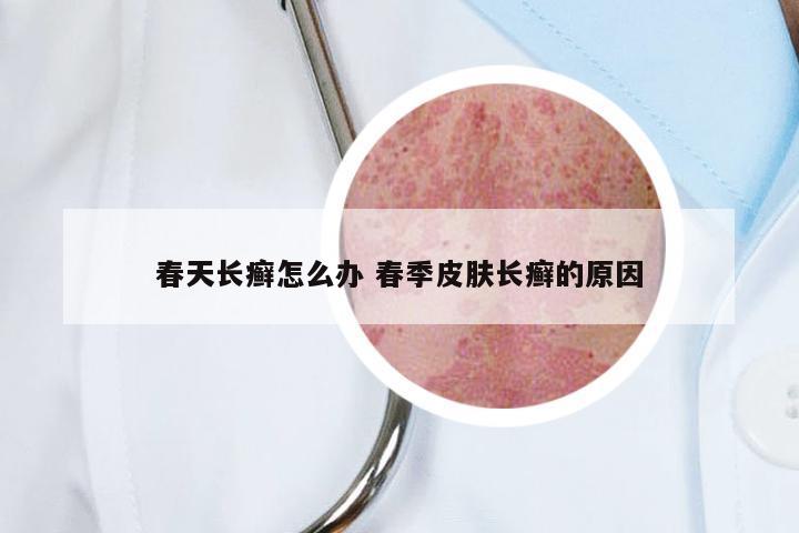 春天长癣怎么办 春季皮肤长癣的原因