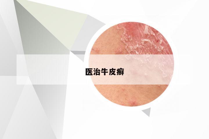 医治牛皮癣