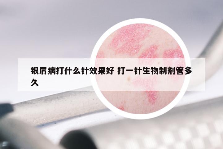 银屑病打什么针效果好 打一针生物制剂管多久