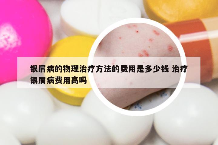 银屑病的物理治疗方法的费用是多少钱 治疗银屑病费用高吗