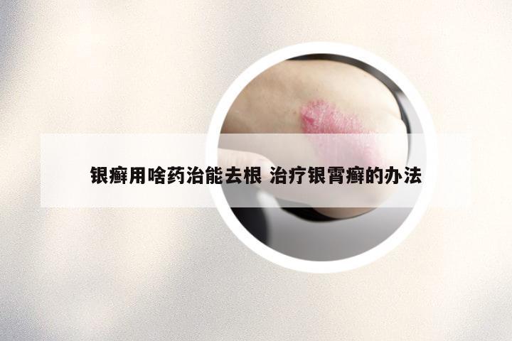 银癣用啥药治能去根 治疗银霄癣的办法