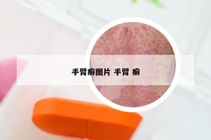 手臂癣图片 手臂 癣