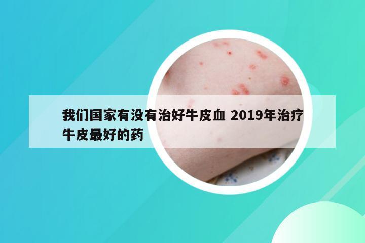 我们国家有没有治好牛皮血 2019年治疗牛皮最好的药