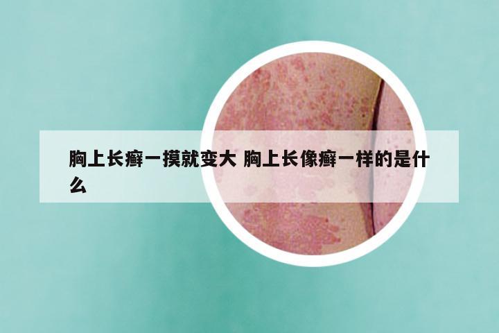 胸上长癣一摸就变大 胸上长像癣一样的是什么