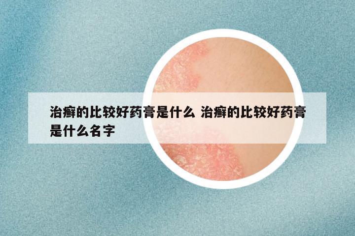 治癣的比较好药膏是什么 治癣的比较好药膏是什么名字
