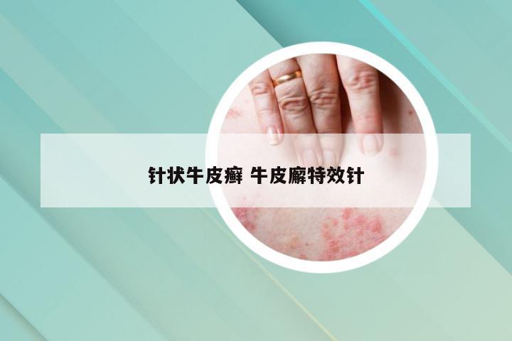 针状牛皮癣 牛皮廨特效针