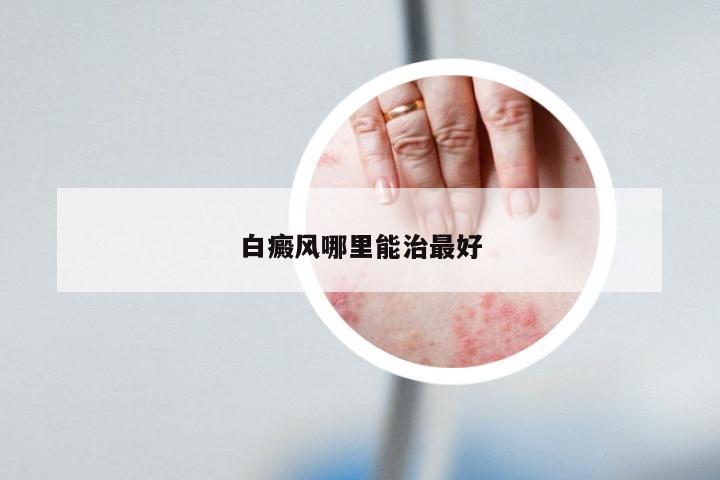 白癜风哪里能治最好