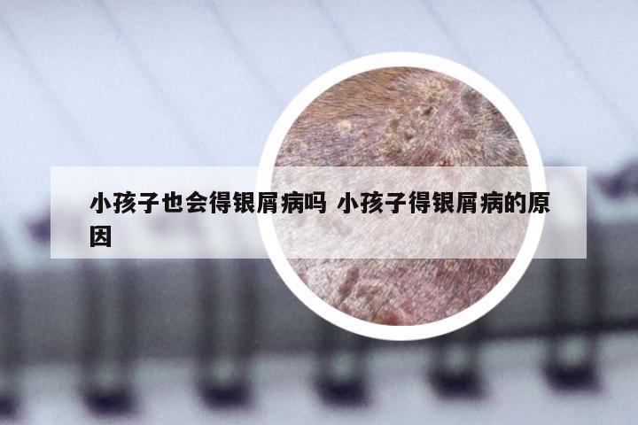 小孩子也会得银屑病吗 小孩子得银屑病的原因