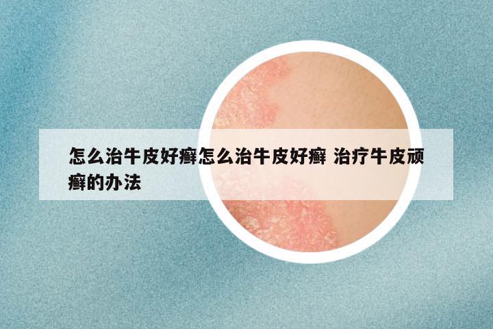 怎么治牛皮好癣怎么治牛皮好癣 治疗牛皮顽癣的办法
