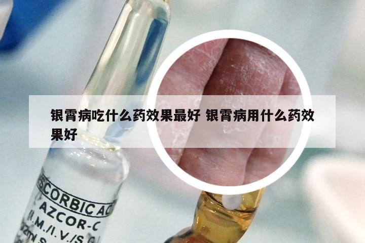 银霄病吃什么药效果最好 银霄病用什么药效果好