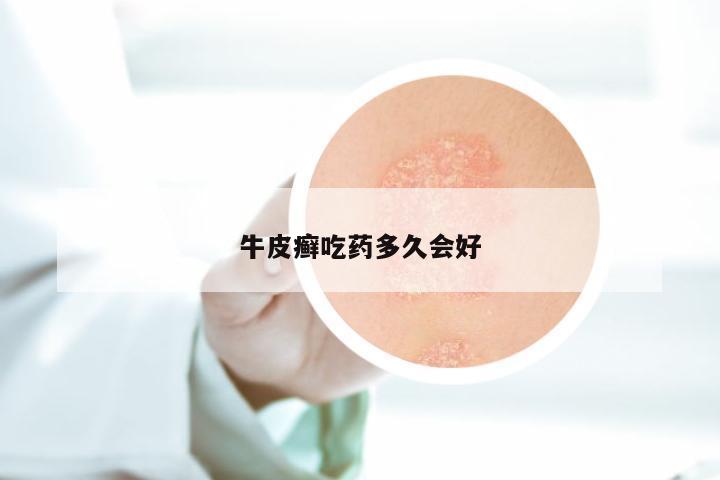 牛皮癣吃药多久会好