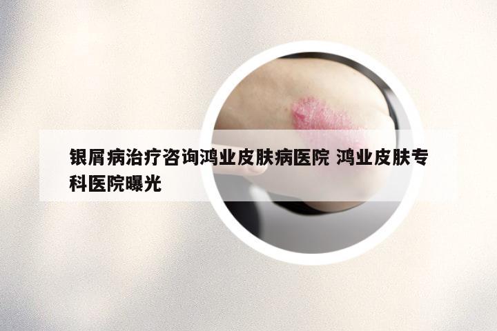 银屑病治疗咨询鸿业皮肤病医院 鸿业皮肤专科医院曝光