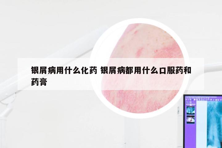 银屑病用什么化药 银屑病都用什么口服药和药膏