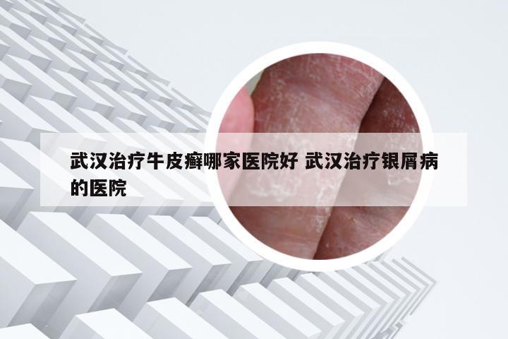 武汉治疗牛皮癣哪家医院好 武汉治疗银屑病的医院
