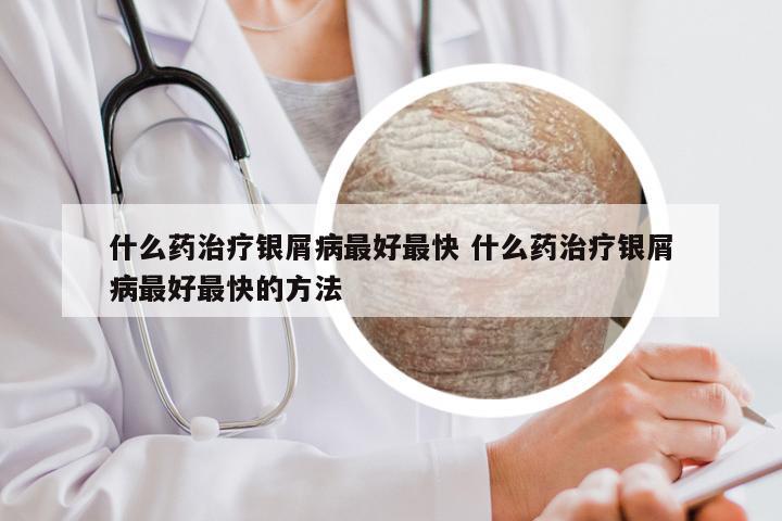 什么药治疗银屑病最好最快 什么药治疗银屑病最好最快的方法