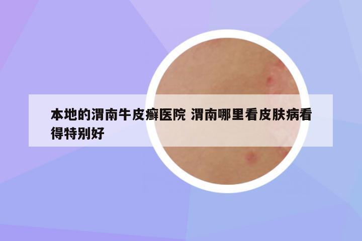 本地的渭南牛皮癣医院 渭南哪里看皮肤病看得特别好