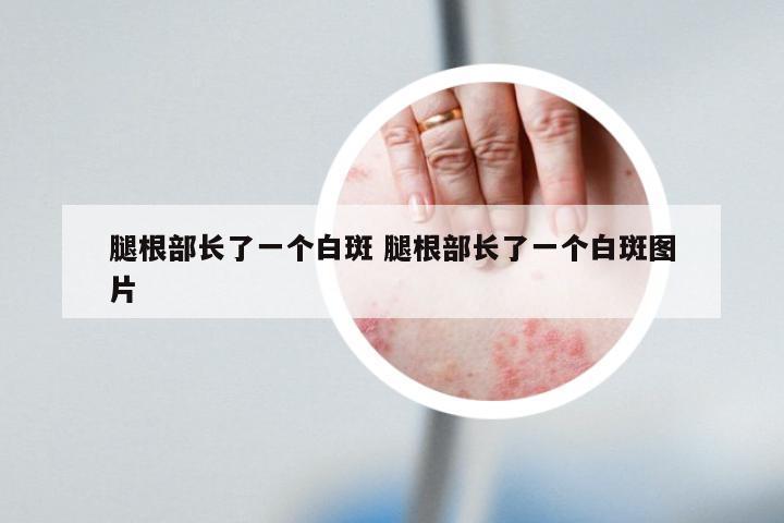 腿根部长了一个白斑 腿根部长了一个白斑图片