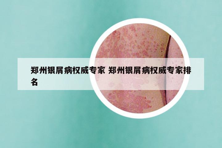 郑州银屑病权威专家 郑州银屑病权威专家排名