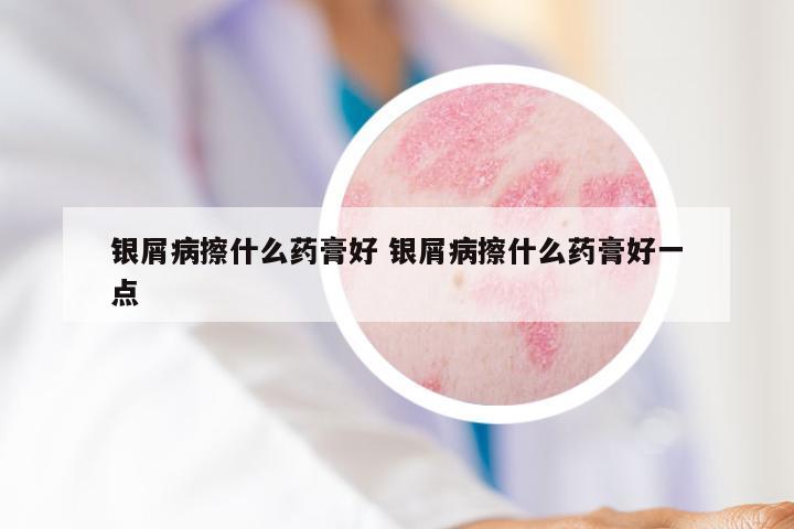 银屑病擦什么药膏好 银屑病擦什么药膏好一点