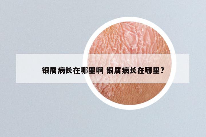 银屑病长在哪里啊 银屑病长在哪里?