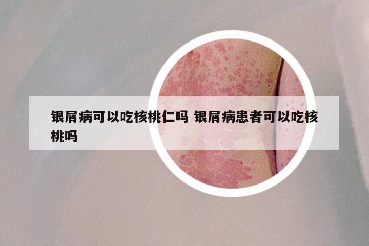 银屑病可以吃核桃仁吗 银屑病患者可以吃核桃吗