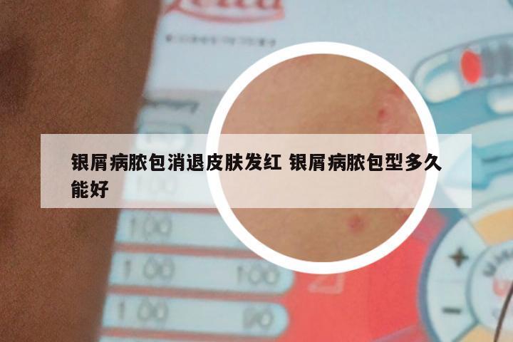银屑病脓包消退皮肤发红 银屑病脓包型多久能好
