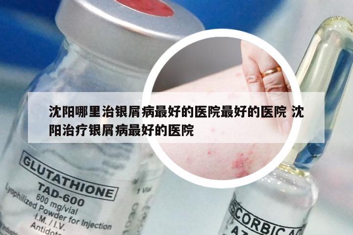 沈阳哪里治银屑病最好的医院最好的医院 沈阳治疗银屑病最好的医院