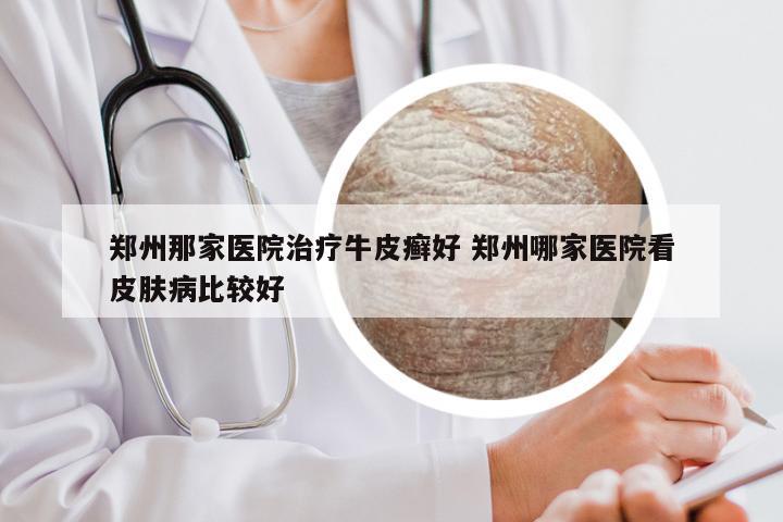 郑州那家医院治疗牛皮癣好 郑州哪家医院看皮肤病比较好