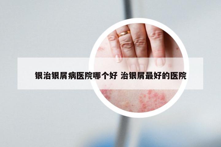 银治银屑病医院哪个好 治银屑最好的医院