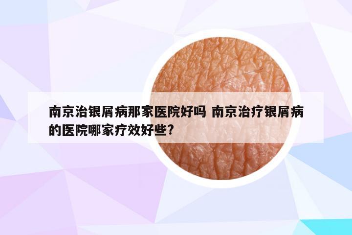 南京治银屑病那家医院好吗 南京治疗银屑病的医院哪家疗效好些?