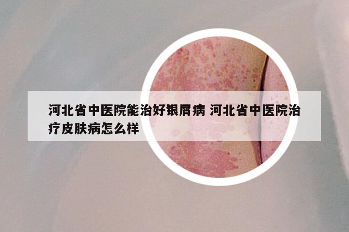 河北省中医院能治好银屑病 河北省中医院治疗皮肤病怎么样