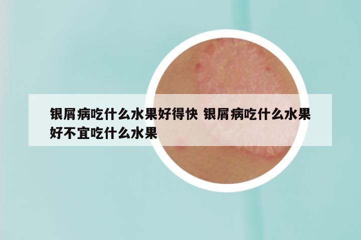 银屑病吃什么水果好得快 银屑病吃什么水果好不宜吃什么水果