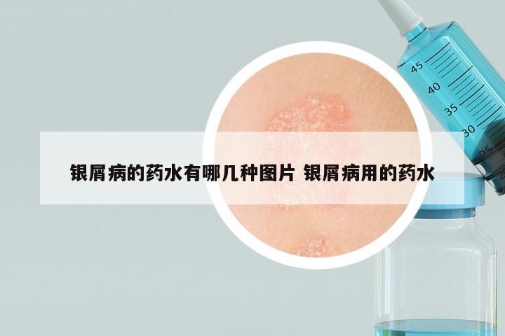 银屑病的药水有哪几种图片 银屑病用的药水