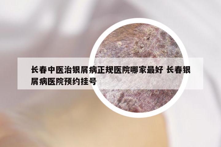 长春中医治银屑病正规医院哪家最好 长春银屑病医院预约挂号