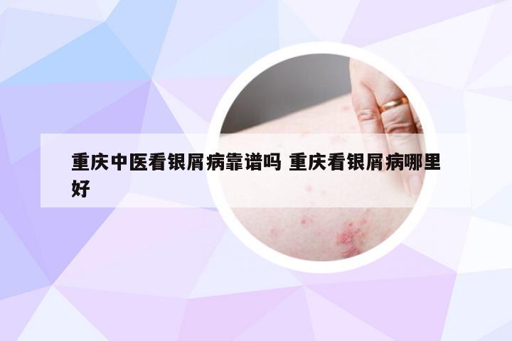 重庆中医看银屑病靠谱吗 重庆看银屑病哪里好