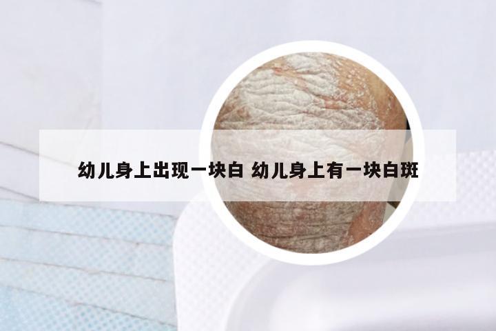 幼儿身上出现一块白 幼儿身上有一块白斑