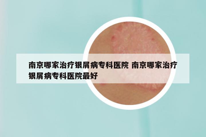 南京哪家治疗银屑病专科医院 南京哪家治疗银屑病专科医院最好