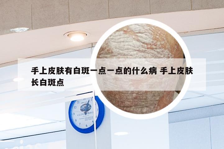 手上皮肤有白斑一点一点的什么病 手上皮肤长白斑点
