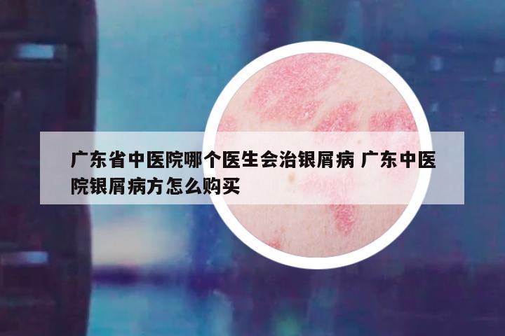 广东省中医院哪个医生会治银屑病 广东中医院银屑病方怎么购买